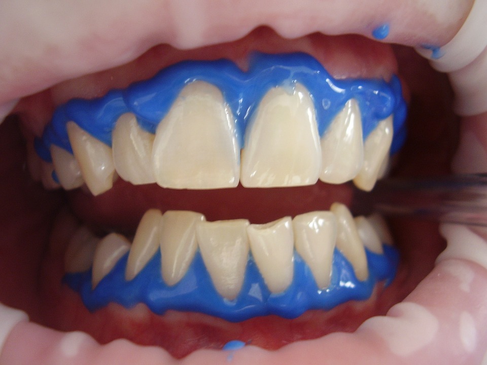  Blanchir les dents : quelles sont les solutions à votre disposition ?